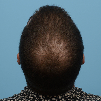 Fue Before and After | Dr. Jeffrey Wise