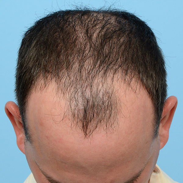 Fue Before and After | Dr. Jeffrey Wise