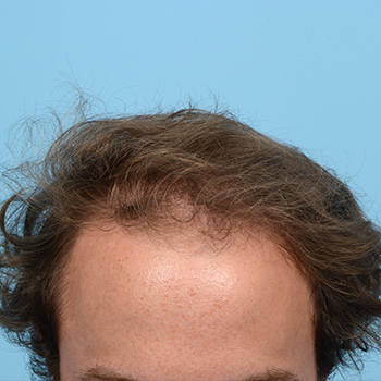 Fue Before and After | Dr. Jeffrey Wise