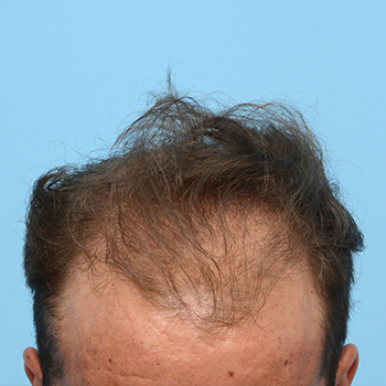 Fue Before and After | Dr. Jeffrey Wise