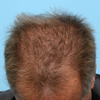 Fue Before and After | Dr. Jeffrey Wise