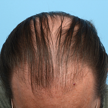 Fue Before and After | Dr. Jeffrey Wise