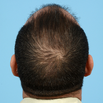 Fue Before and After | Dr. Jeffrey Wise