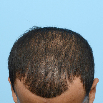 Fue Before and After | Dr. Jeffrey Wise