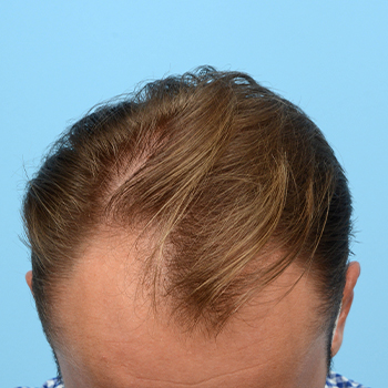 Fue Before and After | Dr. Jeffrey Wise