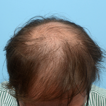 Fue Before and After | Dr. Jeffrey Wise