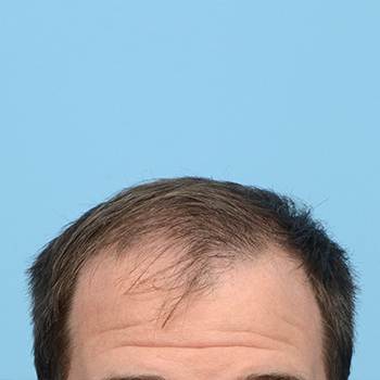 Fue Before and After | Dr. Jeffrey Wise