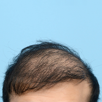 Fue Before and After | Dr. Jeffrey Wise