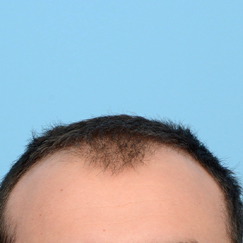 Fue Before and After | Dr. Jeffrey Wise