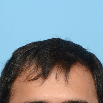 Fue Before and After | Dr. Jeffrey Wise