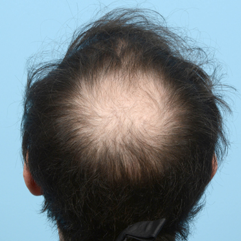 Fue Before and After | Dr. Jeffrey Wise