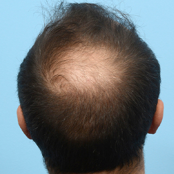 Fue Before and After | Dr. Jeffrey Wise