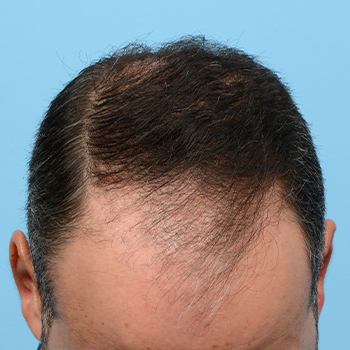 Fue Before and After | Dr. Jeffrey Wise