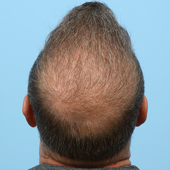 Fue Before and After | Dr. Jeffrey Wise