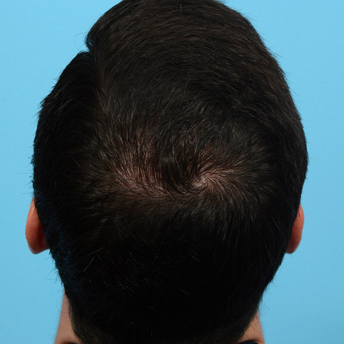 Fue Before and After | Dr. Jeffrey Wise