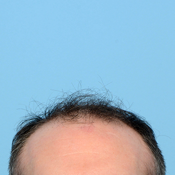 Fue Before and After | Dr. Jeffrey Wise