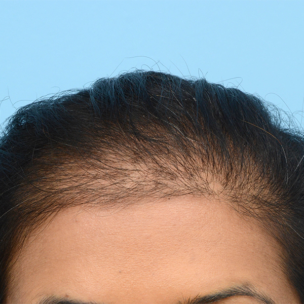 Fue Before and After | Dr. Jeffrey Wise