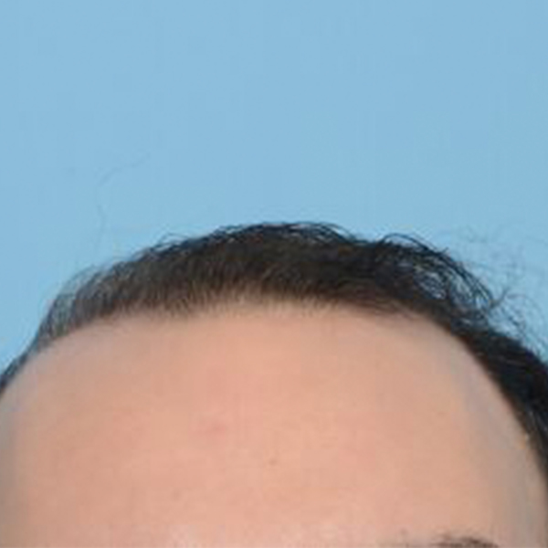 Fue Before and After | Dr. Jeffrey Wise