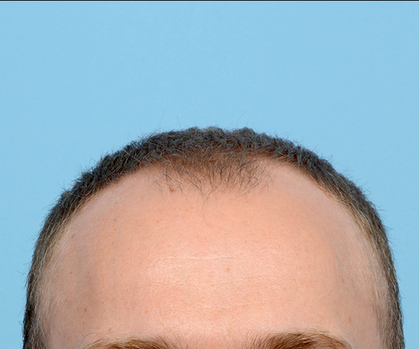 Fue Before and After | Dr. Jeffrey Wise