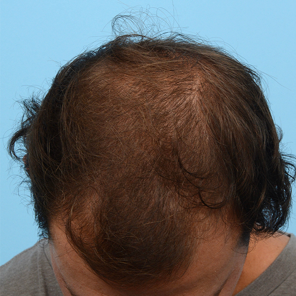 Fue Before and After | Dr. Jeffrey Wise