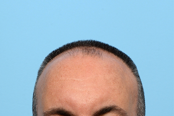 Fue Before and After | Dr. Jeffrey Wise