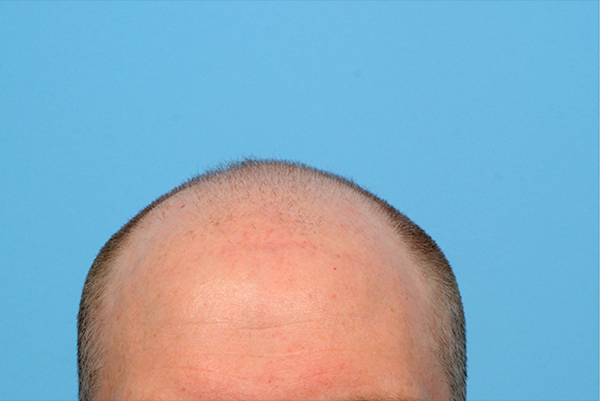 Fue Before and After | Dr. Jeffrey Wise