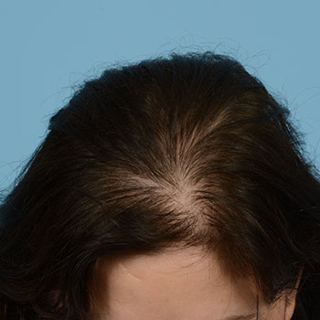 FUT Hair Transplant Treatment NJ