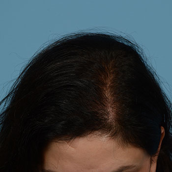 FUT Hair Transplant Treatment NJ